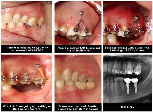 super erupted teeth intrusion with mini implant temporary anchorage device Tads